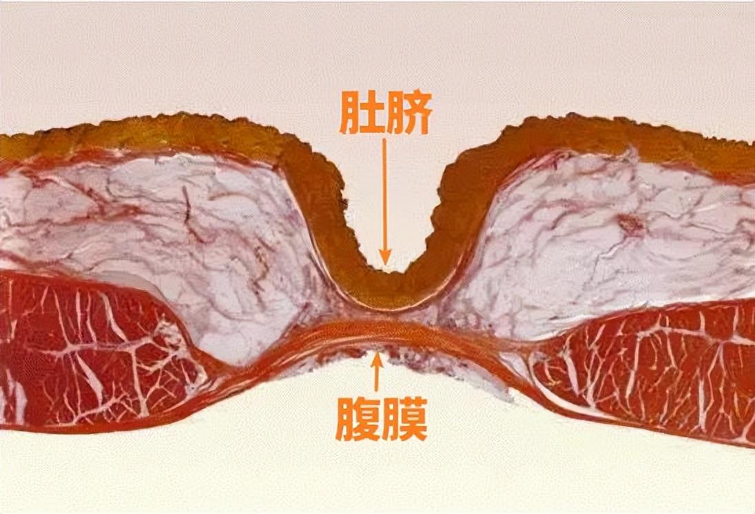 宝宝肚脐护理，几个月后肚脐不怕水