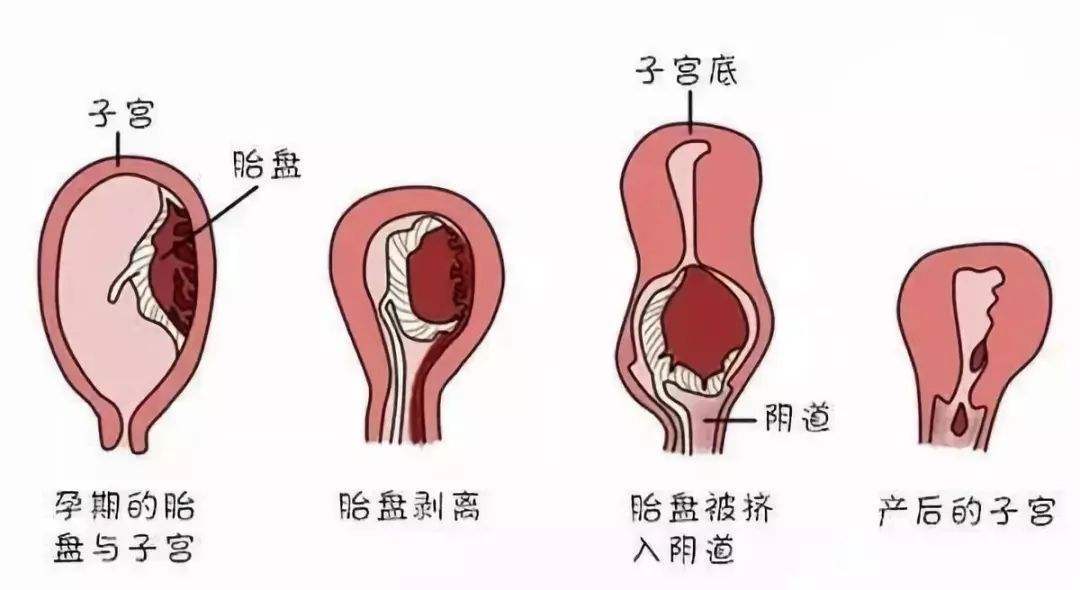 三个月流产后的恢复与同房时间考量