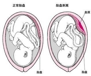 胎盘低置的处理与应对措施，怀孕三个月的特别关注